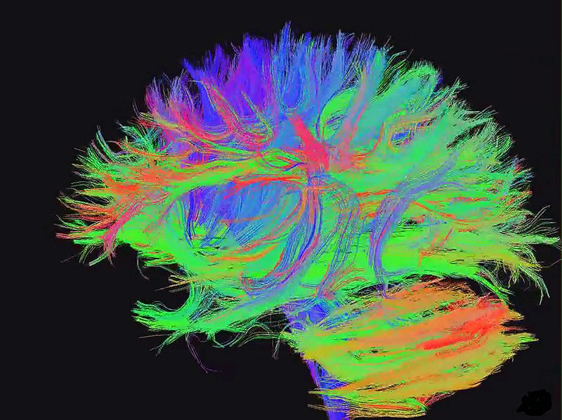 DT image of the brain