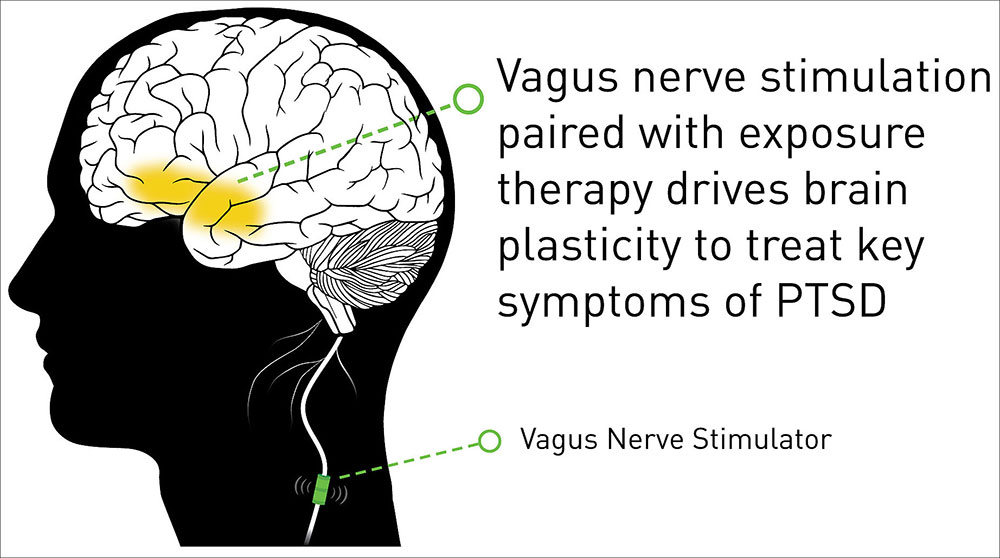 Illustration of vagus nerve stimulation therapy